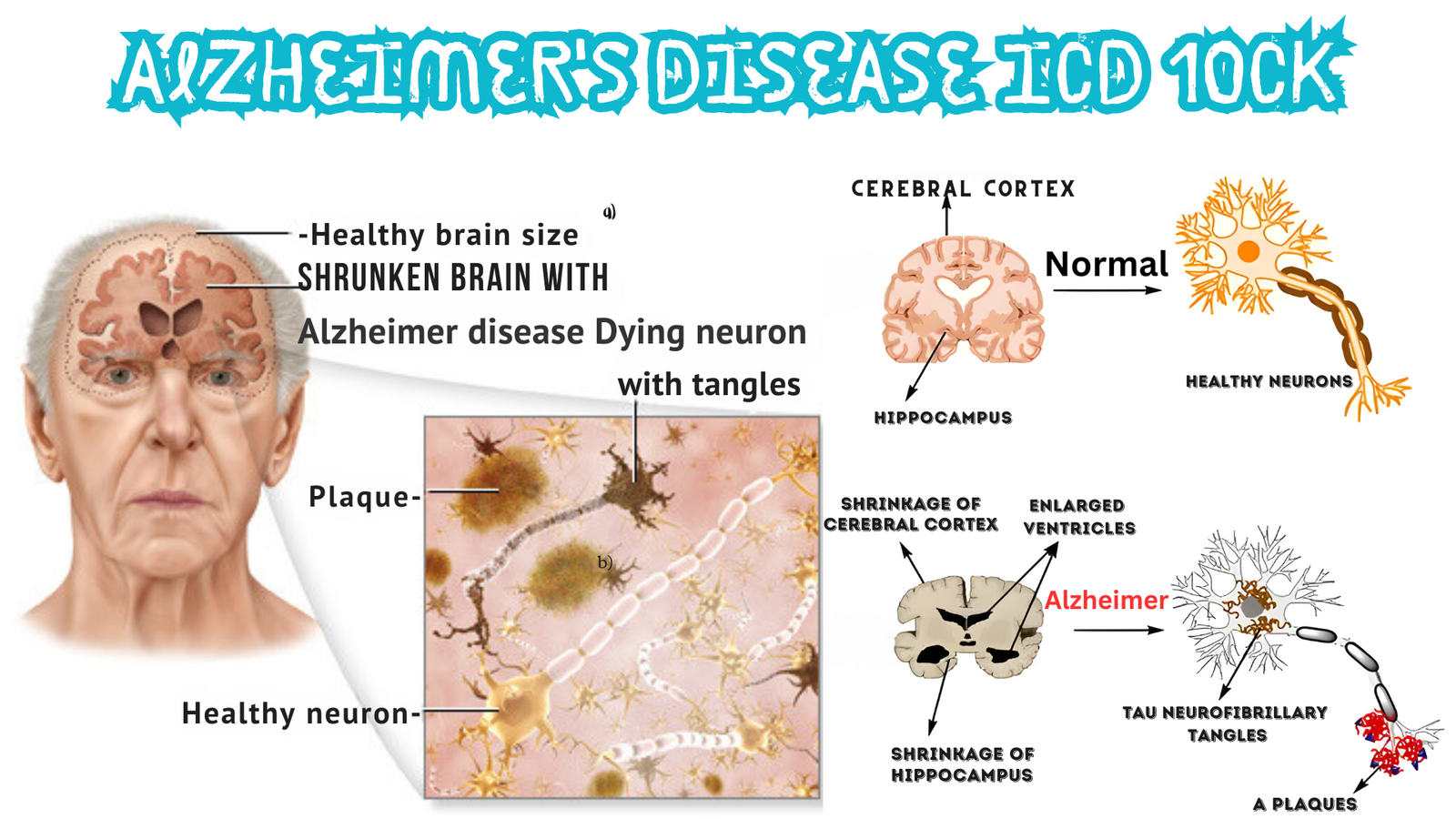 Alzheimer's Disease ICD 10