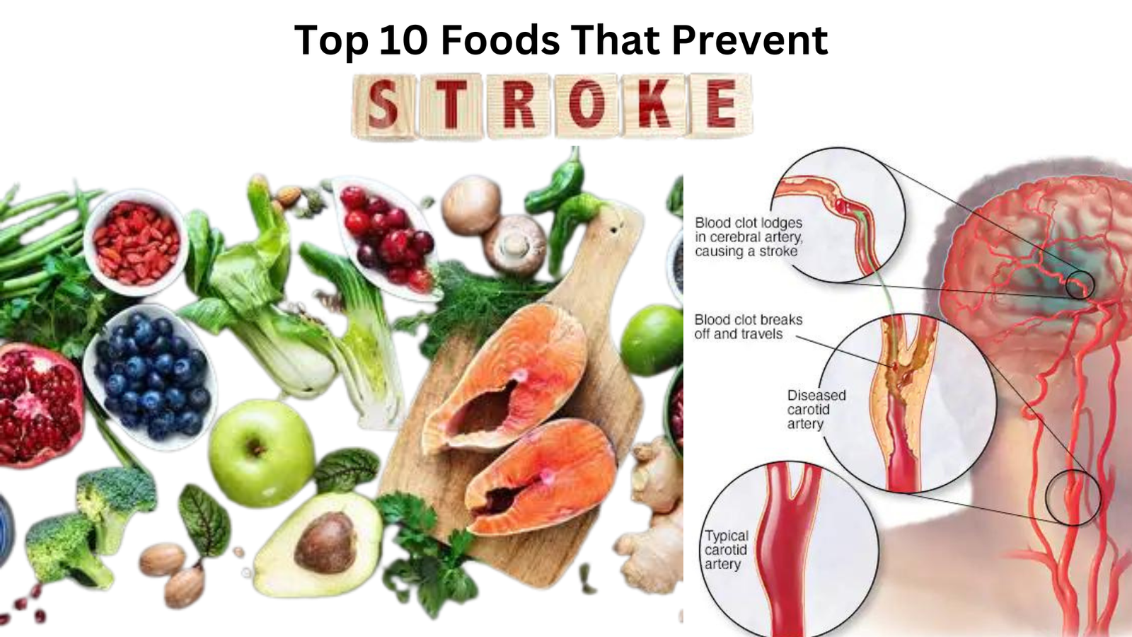 Top 10 Foods That Prevent Stroke