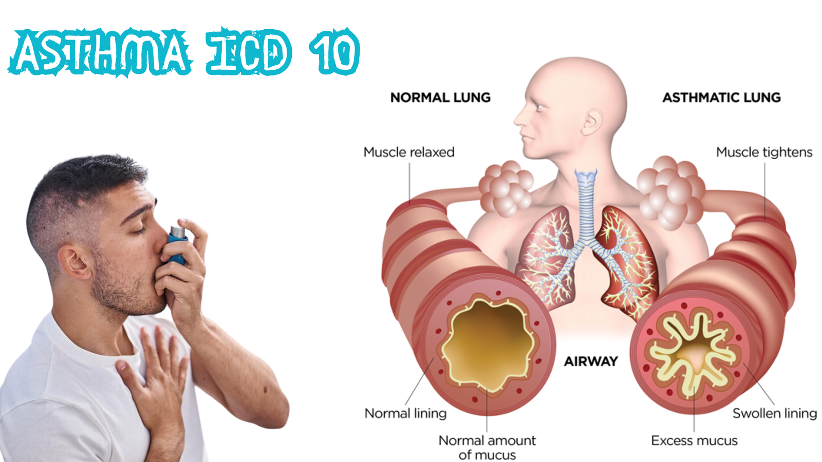 Asthma ICD 10