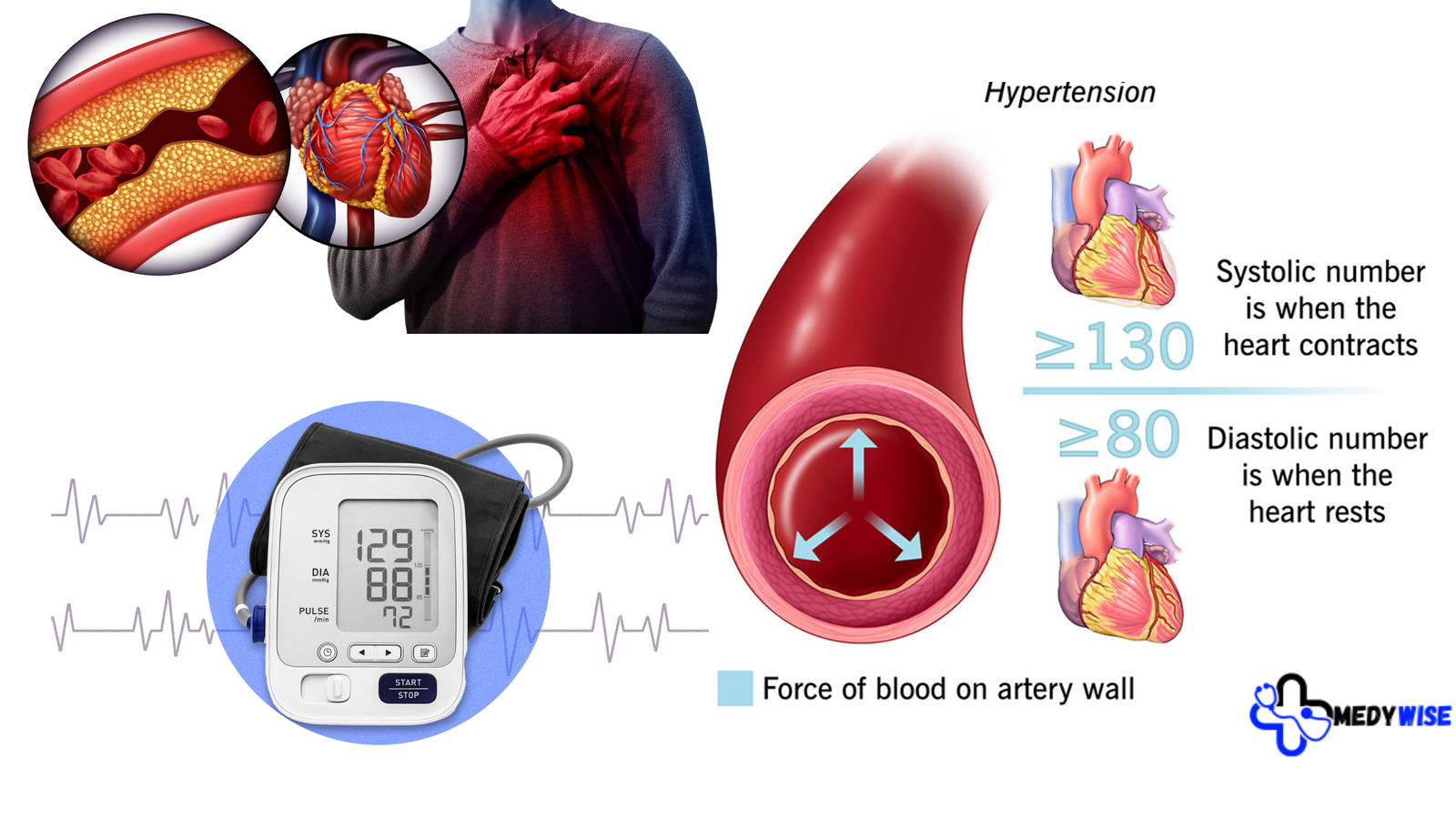 Diagram explaining hypertension self-care, showing the impact of high blood pressure on arteries and the importance of monitoring systolic and diastolic numbers.